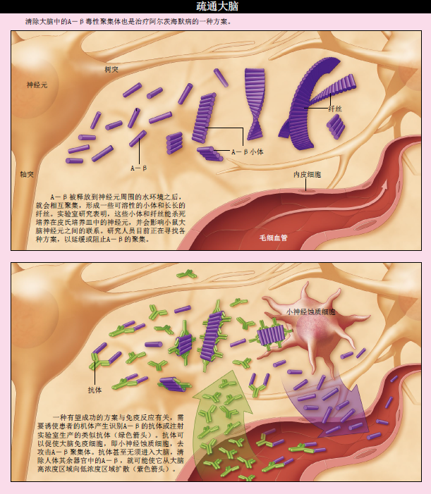 阿尔茨海默病 (3).png