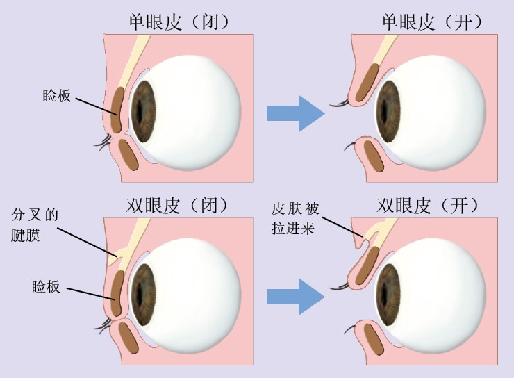 20130574眼皮_f2.jpg